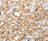 Immunohistochemistry of paraffin-embedded Human thyroid cancer using Cathepsin E Polyclonal Antibody at dilution of 1:40