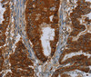 Immunohistochemistry of paraffin-embedded Human esophagus cancer using ERBB4 Polyclonal Antibody at dilution of 1:40