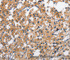 Immunohistochemistry of paraffin-embedded Human thyroid cancer tissue using CLEC2D Polyclonal Antibody at dilution 1:70