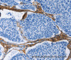 Immunohistochemistry of paraffin-embedded Human lung cancer tissue using COL3A1 Polyclonal Antibody at dilution 1:60