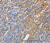 Immunohistochemistry of paraffin-embedded Human prostate cancer tissue using COL3A1 Polyclonal Antibody at dilution 1:60