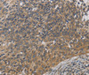 Immunohistochemistry of paraffin-embedded Human cervical cancer using EMC8 Polyclonal Antibody at dilution of 1:30