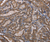 Immunohistochemistry of paraffin-embedded Human thyroid cancer using CUL3 Polyclonal Antibody at dilution of 1:30