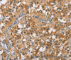 Immunohistochemistry of paraffin-embedded Human thyroid cancer tissue using CUL7 Polyclonal Antibody at dilution 1:50