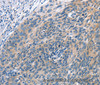 Immunohistochemistry of paraffin-embedded Human cervical cancer tissue using CUL7 Polyclonal Antibody at dilution 1:50
