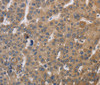Immunohistochemistry of paraffin-embedded Human liver cancer using SDCCAG3 Polyclonal Antibody at dilution of 1:30