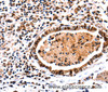 Immunohistochemistry of paraffin-embedded Human stomach cancer tissue using DNMT3A Polyclonal Antibody at dilution 1:65