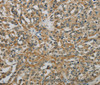 Immunohistochemistry of paraffin-embedded Human esophagus cancer using E2F6 Polyclonal Antibody at dilution of 1:60