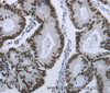 Immunohistochemistry of paraffin-embedded Human colon cancer using ELN Polyclonal Antibody at dilution of 1:50