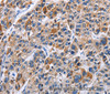 Immunohistochemistry of paraffin-embedded Human liver cancer tissue using ENPP5 Polyclonal Antibody at dilution 1:40