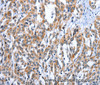 Immunohistochemistry of paraffin-embedded Human esophagus cancer tissue using EDN3 Polyclonal Antibody at dilution 1:30