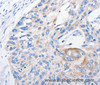 Immunohistochemistry of paraffin-embedded Human esophagus cancer tissue using FANCF Polyclonal Antibody at dilution 1:100