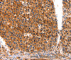 Immunohistochemistry of paraffin-embedded Human liver cancer tissue using FGFR1 Polyclonal Antibody at dilution 1:60