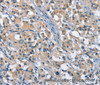 Immunohistochemistry of paraffin-embedded Human thyroid cancer tissue using GAS2 Polyclonal Antibody at dilution 1:50