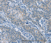 Immunohistochemistry of paraffin-embedded Human gastric cancer tissue using GAS2 Polyclonal Antibody at dilution 1:50