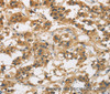 Immunohistochemistry of paraffin-embedded Human thyroid cancer using GAS7 Polyclonal Antibody at dilution of 1:50