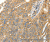 Immunohistochemistry of paraffin-embedded Human ovarian cancer using CALR Polyclonal Antibody at dilution of 1:50
