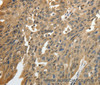 Immunohistochemistry of paraffin-embedded Human ovarian cancer using GSR Polyclonal Antibody at dilution of 1:50
