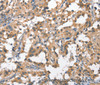 Immunohistochemistry of paraffin-embedded Human thyroid cancer tissue using HGF Polyclonal Antibody at dilution 1:65