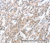 Immunohistochemistry of paraffin-embedded Human esophagus cancer tissue using HDAC8 Polyclonal Antibody at dilution 1:50