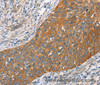 Immunohistochemistry of paraffin-embedded Human cervical cancer tissue using Crystallin-alpha C Polyclonal Antibody at dilution 1:45