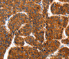 Immunohistochemistry of paraffin-embedded Human liver cancer using HSP75 Polyclonal Antibody at dilution of 1:100