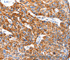 Immunohistochemistry of paraffin-embedded Human esophagus cancer using HSP75 Polyclonal Antibody at dilution of 1:100