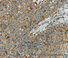 Immunohistochemistry of paraffin-embedded Human cervical cancer using AIF1 Polyclonal Antibody at dilution of 1:40