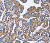 Immunohistochemistry of paraffin-embedded Human thyroid cancer tissue using IGSF10 Polyclonal Antibody at dilution 1:50