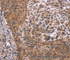 Immunohistochemistry of paraffin-embedded Human cervical cancer tissue using ING2 Polyclonal Antibody at dilution 1:60
