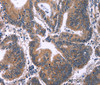 Immunohistochemistry of paraffin-embedded Human colon cancer tissue using ING2 Polyclonal Antibody at dilution 1:60