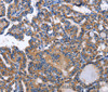 Immunohistochemistry of paraffin-embedded Human thyroid cancer using INHBC Polyclonal Antibody at dilution of 1:50