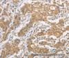 Immunohistochemistry of paraffin-embedded Human gasrtic cancer tissue using ITGB3BP Polyclonal Antibody at dilution 1:50