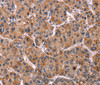 Immunohistochemistry of paraffin-embedded Human liver cancer tissue using LILRB1 Polyclonal Antibody at dilution 1:50