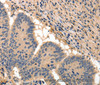 Immunohistochemistry of paraffin-embedded Human colon cancer tissue using BAIAP2 Polyclonal Antibody at dilution 1:50