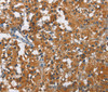 Immunohistochemistry of paraffin-embedded Human thyroid cancer using KLF7 Polyclonal Antibody at dilution of 1:60