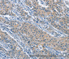 Immunohistochemistry of paraffin-embedded Human gastric cancer using KLF7 Polyclonal Antibody at dilution of 1:60