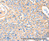 Immunohistochemistry of paraffin-embedded Human esophagus cancer using MVP Polyclonal Antibody at dilution of 1:30