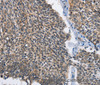 Immunohistochemistry of paraffin-embedded Human lung cancer tissue using MAD2L1BP Polyclonal Antibody at dilution 1:60