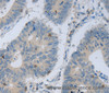 Immunohistochemistry of paraffin-embedded Human colon cancer using MAGEB4 Polyclonal Antibody at dilution of 1:40