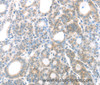 Immunohistochemistry of paraffin-embedded Human thyroid cancer using MAGED1 Polyclonal Antibody at dilution of 1:30