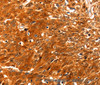 Immunohistochemistry of paraffin-embedded Human esophagus cancer using SERPINB5 Polyclonal Antibody at dilution of 1:60