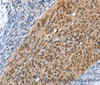 Immunohistochemistry of paraffin-embedded Human cervical cancer using MCM6 Polyclonal Antibody at dilution of 1:45