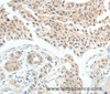 Immunohistochemistry of paraffin-embedded Human lung cancer tissue using MDK Polyclonal Antibody at dilution 1:60