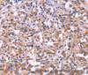 Immunohistochemistry of paraffin-embedded Human thyroid cancer tissue using MMP14 Polyclonal Antibody at dilution 1:40