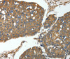Immunohistochemistry of paraffin-embedded Human breast cancer using MSN Polyclonal Antibody at dilution of 1:30