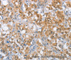 Immunohistochemistry of paraffin-embedded Human thyroid cancer tissue using MLH1 Polyclonal Antibody at dilution 1:65