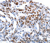 Immunohistochemistry of paraffin-embedded Human ovarian cancer using MUTYH Polyclonal Antibody at dilution of 1:60