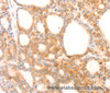 Immunohistochemistry of paraffin-embedded Human thyroid cancer using NAP1L1 Polyclonal Antibody at dilution of 1:70