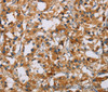 Immunohistochemistry of paraffin-embedded Human thyroid cancer tissue using NRN1 Polyclonal Antibody at dilution of 1:40